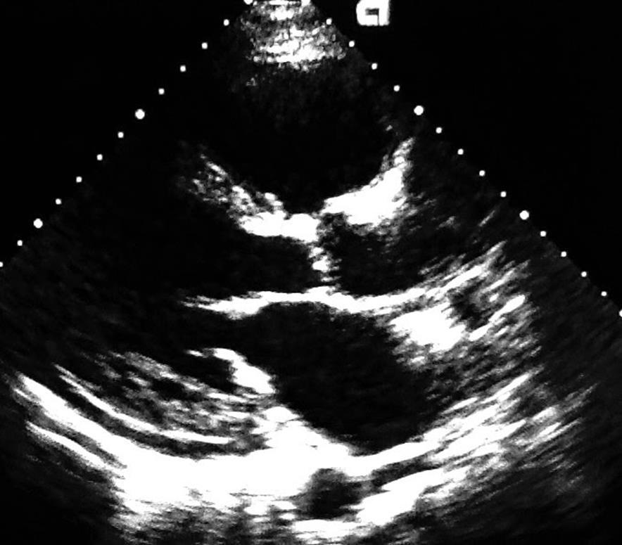 Low Flow, Low Gradient Aortic Stenosis with Reduced Ejection Fraction (< 50%) Stroke