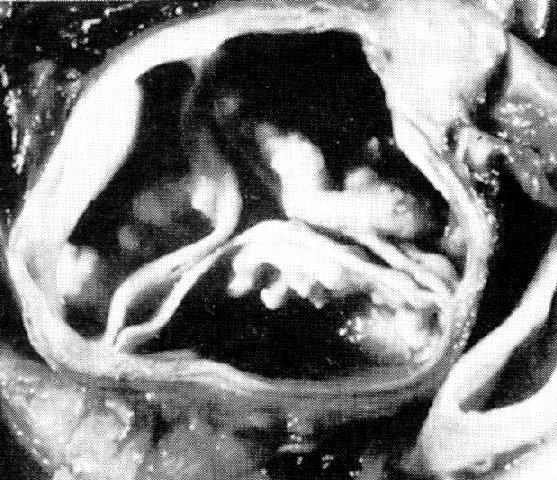 Aortic Stenosis Aortic valve area: Ross J, Braunwald E. Circulation 1968; 38: 61-67.
