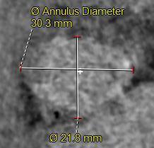 CT Images: Annulus Measurements Clinical Analyst s Image Ao Annulus mean diameter 26.