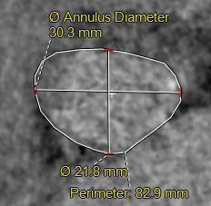 9_ Aortic Annulus perimeter (26.4 x 3.14) 33.5 Max Ascending Aorta diameter 35.9-31.