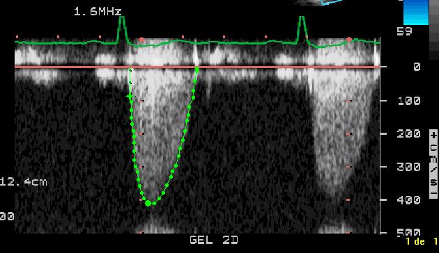 Case Study : High Doppler Gradient in Aortic Valve Prosthesis