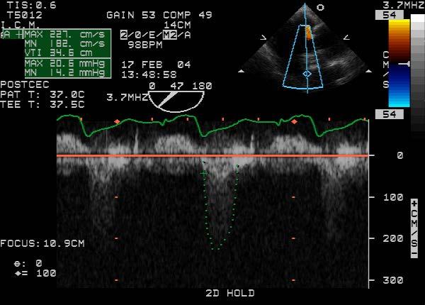 Intraoperative echo after prosthesis St. Jude Regent # 21 Suprannular (reference EOA: 2.