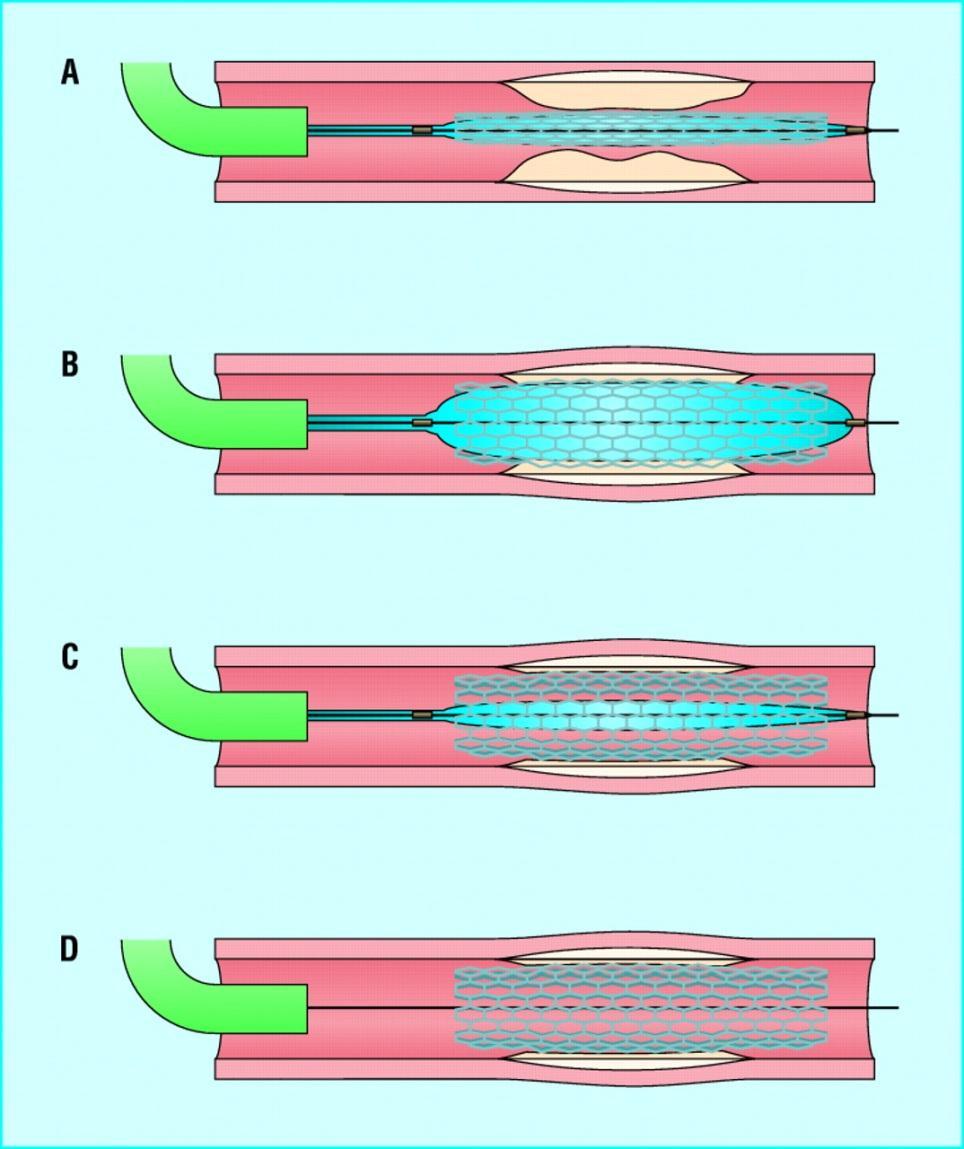 Surgical treatments for PAD Balloon Angioplasty, with or without stenting Cutting