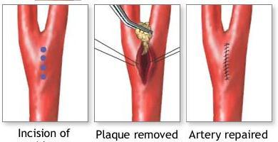 The catheter is designed to collect the removed plaque in a chamber in the tip of