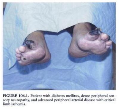It s not only CAD death Some facts about amputation Uncorrected PAD, especially in diabetics, may eventually cause CLI - critical limb ischemia Involves non-healing ulceration or gangrene of the foot