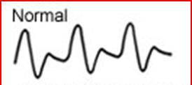 Normal Arterial Circulation Normal triphasic flow pattern Rapid