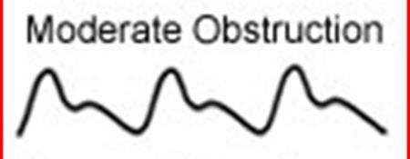 Moderate Arterial Insufficiency Absence of diastolic flow reversal suggesting forward flow