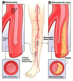 Arterial Occlusive Disease Peripheral Arterial Disease Asymptomatic Claudication