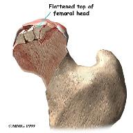 All of the blood supply comes into the ball that forms the hip joint through the neck of the femur bone (the femoral neck), a thinner area of bone that connects the ball to the shaft.