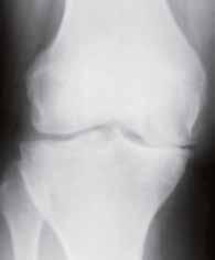 The surface of the kneecap, thigh bone and shin bone, where the bones come in contact, is coated with a smooth tissue