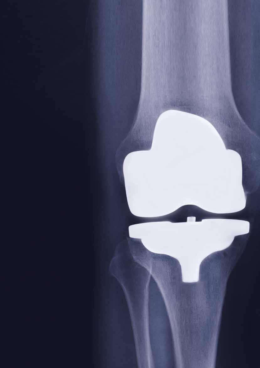 EMENT WHY TOTAL KNEE REPLACEMENT? With almost 50 years of history, total knee replacement surgery is a very common and safe procedure for the treatment of severe arthritis.