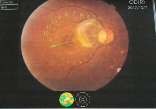 Figure 1: OCTshowing macular bleeding in the right eye, Hyperreflectivity in the middle retinal layer of macula.