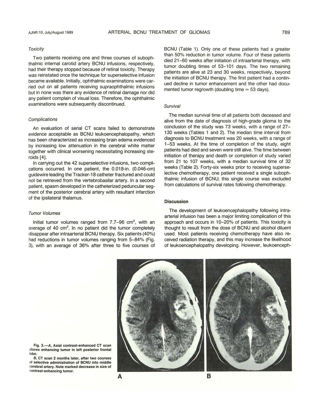 AJNR :1 0, July/August 1989 ARTERIAL BCNU TREATMENT OF GLIOMAS 769 Toxicity Two patients receiving one and three courses of subophthalmic internal carotid artery BCNU infusions, respectively, had