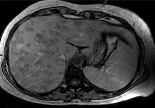 Imaging of Fat-ontaining Liver Lesions particularly the appearance, which may range from hypointense to iso- or hyperintense on T1-weighted images and from hypointense to hyperintense on T2-weighted
