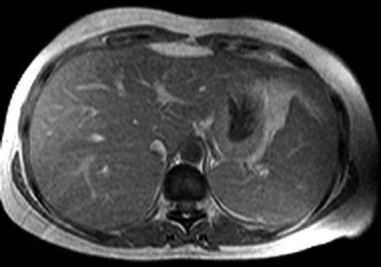 Some investigators have suggested that fatty metamorphosis is the principal cause of hyperintensity on T1-weighted images of some Hs and that this finding can help in establishing the diagnosis [4,
