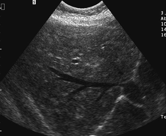 45-year-old woman who had prior ovarian cancer surgery and multiple liver lesions., Sonogram shows multiple hyperechogenic lesions.