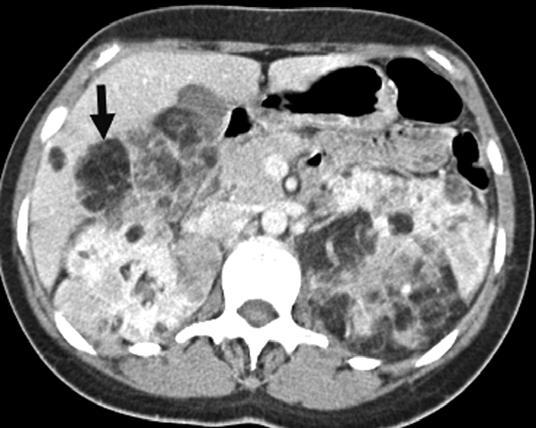 Imaging of Fat-ontaining Liver Lesions Fig. 5. 29-year-old woman with tuberous sclerosis. xial image shows fat-containing liver lesion (arrow) consistent with hepatic angiomyolipoma.