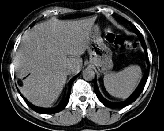 fat depicted on MR images of FNH, and they considered it as an exaggerated expression of this patient s native hepatic disease characterized by fatty liver [7].