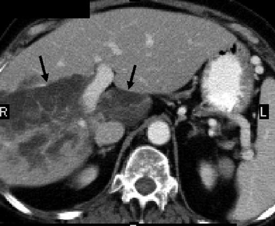asaran et al. Fig. 7. 45-year-old woman with acute leukemia. xial image shows fat-containing lesion (arrows) in right lobe extending to caudate lobe that was not present on 1 year ago.