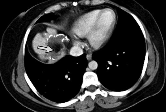 Imaging of Fat-ontaining Liver Lesions Fig. 9. 40-year-old woman with prior hydatid cyst surgery.