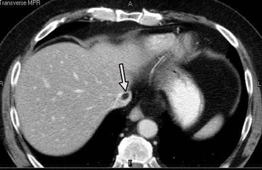 Primary liver liposarcoma is extremely rare, and what is believed to be the first reported case was published in 1987.