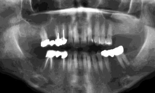 Radiograph showing augmentation in left Maxillary sinus floor