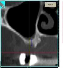CT Scan of de novo Bone Pre-Op (3.
