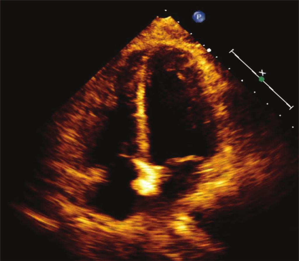 Figure 4: Transthoracic ECHO (4-chamber) view post-lung transplant, showing normal rightsided chambers, illustrating resolution of previous right atrial and ventricular dilation.