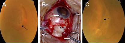 H.Y. Min et al. 6668 Figure 2. Rhegmatogenous retinal detachment (RRD) with a horse-toe tear treated by one 8 shaped scleral suture. A. RRD with a 2DD tear and its flap (black arrow) before surgery.