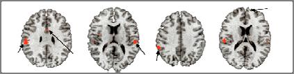 fmri imaging of cerebral pain responses Regions in which the activity was