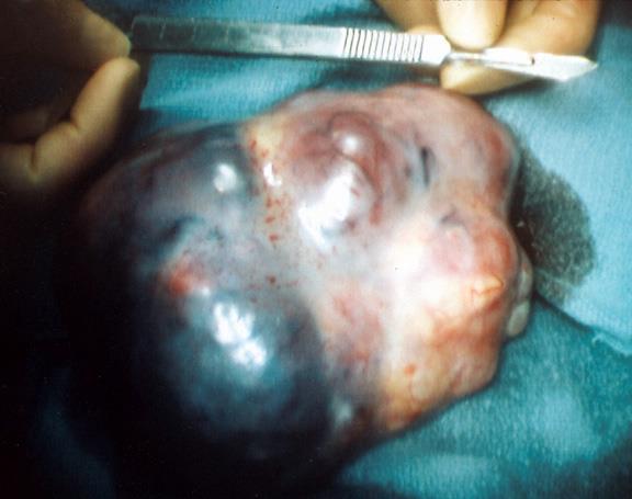 germ cell tumor endodermal sinus tumor(yolk sac tumor) highly malignant adolescence and early adult