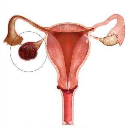 outlines of ovarian