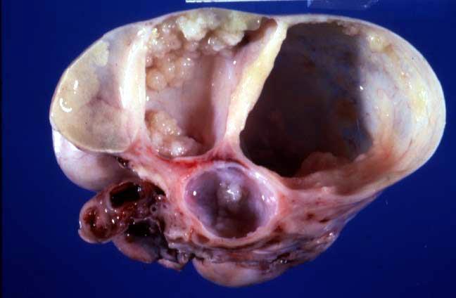 borderline serous cystadenoma medium size, more bilateral, few papilloma inside the cyst