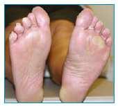 Hand-Foot Skin Reaction (HFSR) HFSR over time HFSR is distinct from the more widely known hand foot syndrome (HFS also known as PPE, palmar-plantar