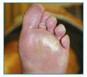 friction, such as the palms of the hand, soles of the feet, fingers or toes 1,2 HFSR typically develops soon (2 4 weeks) after a patient starts treatment 2
