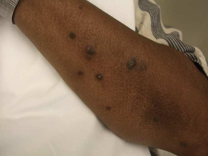 scalp), eczema Subungual splinter haemorrhages (30%)