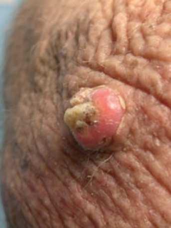 haemorrhages Sorafenib: keratinocyte neoplasia