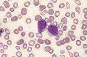 In patients in the lymphoid blastic phase, the rate of response is approximately 50%, but