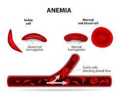 Results: The results are that sickle cells can cause clotting. I have found that once a sickle cell sticks to the vein wall the normal blood cells and the sickle cells begin to stick to each other.