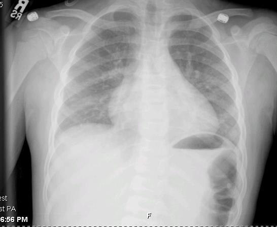 Acute Chest Syndrome- Acute chest syndrome can be defined as the presence of respiratory symptoms, fever and associated radiographic changes representing a severe and often rapidly progressive
