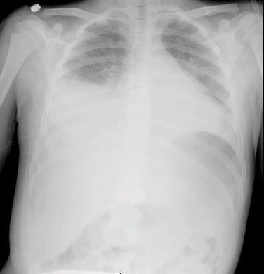 As this is a potentially lifethreatening complication of SCD, suspicion of acute chest syndrome should be reason to pursue prompt and thorough evaluation of the patient. Figure 7.
