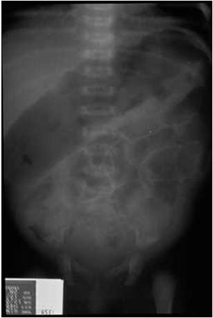 HIRSCHSPRUNG DISEASE What is it? Absence of the intramural ganglion cells in the rectum, extends to the sigmoid in 77%, & involves the entire colon in 15% of pts 1/5,000 births.