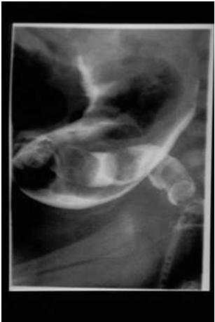 HIRSCHSPRUNG DISEASE Diagnosis Barium enema: Cone-shaped transition zone with dilated segment of