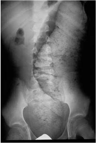 HIRSCHSPRUNG DISEASE Complications of surgery Perineal abscess formation Enterocolitis in up to 9% of pts