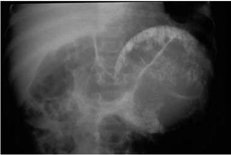 SUMMARY Suspect intussusception in the afebrile, vomiting child