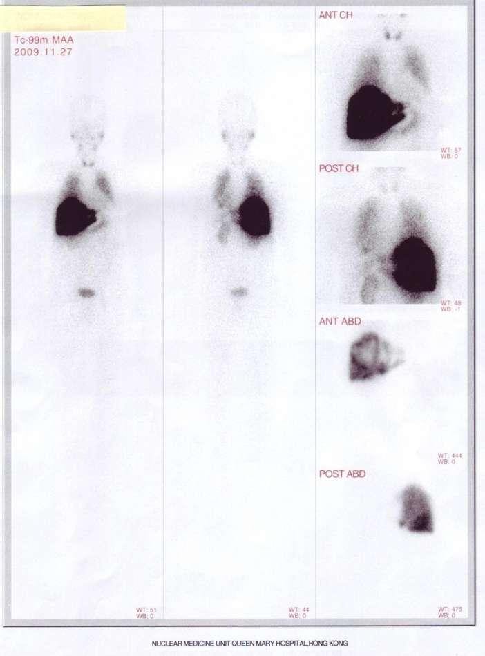 Use of 4 mci 99m Tc-MAA diagnostic NM scan Suggest to NM image right after the Tc99m-MAA infusion.