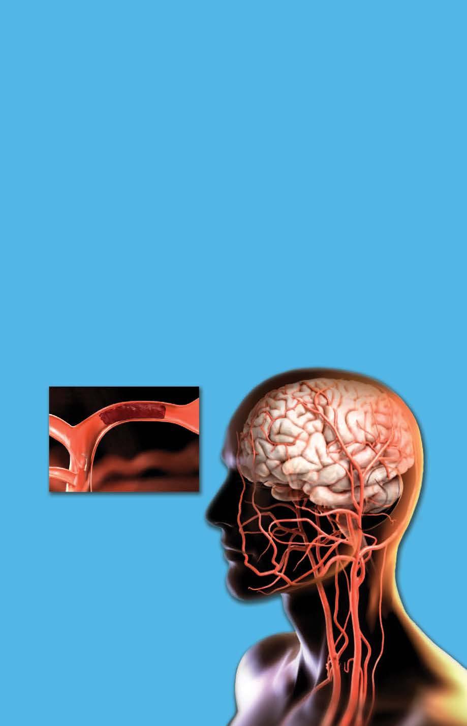 Ischemic Stroke Therapies What is Ischemic Stroke? An ischemic stroke occurs as a result of a blood clot in an artery blocking the flow of blood to the brain.