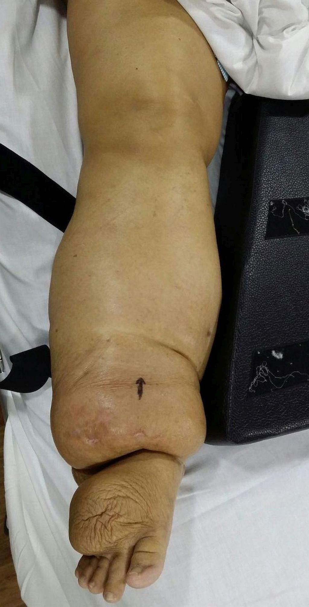 FIGURE 1: Clinical picture showing chronic lymphedema of the