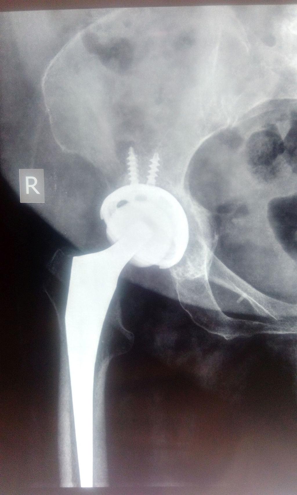 FIGURE 2: Immediate postoperative X-Ray of right hip.