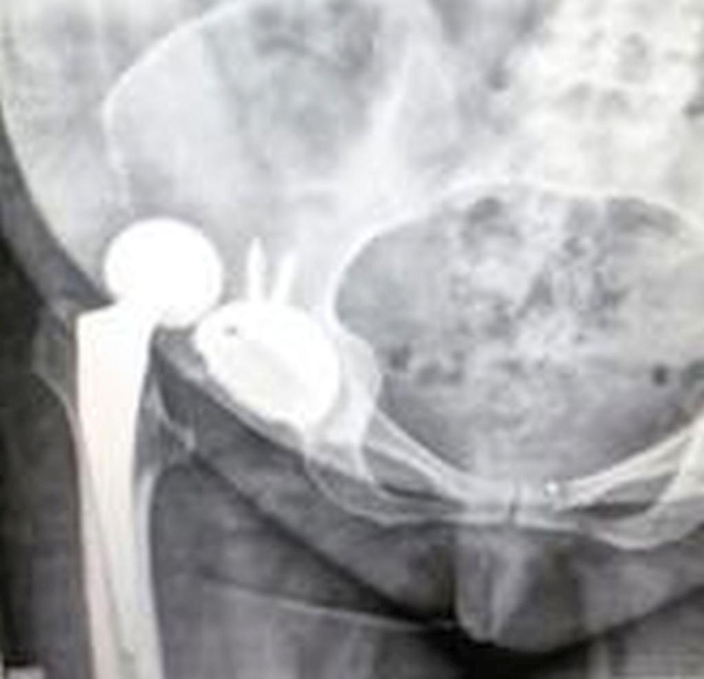 Radiographs showed posterior dislocation of the total hip prosthesis (Figure 4). FIGURE 4: One month postoperative X-Ray of right hip.